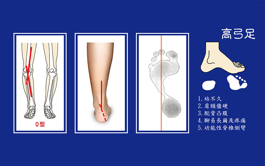 高弓足-O型腿